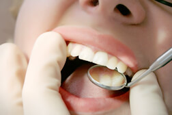 歯の状態を確認