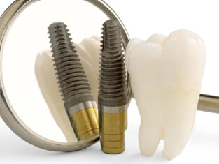⑤ インプラント治療