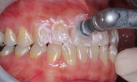 PMTC（プロによる歯のクリーニング）