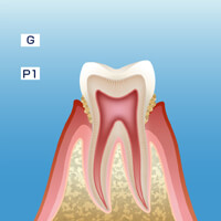 軽度の歯周病