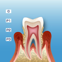重度の歯周病