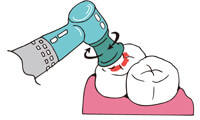 ２．歯の表面の研磨