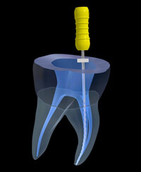 歯根（歯の根っこ）治療