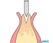 スプリットレスト