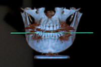 歯科用CTについて