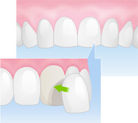 ラミネートベニア
