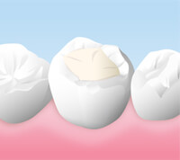 コンポジットレジン(保険適用)