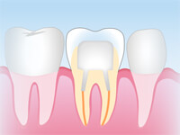 ファイバーコア(保険適用外)