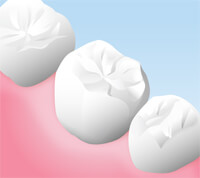 オールセラミッククラウン、インレー