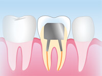 メタルコア(保険適用)