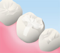 オールセラミッククラウン、インレー