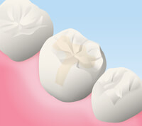 ハイブリッドセラミッククラウン、インレー