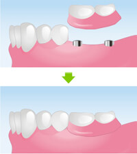 磁性アタッチメント義歯