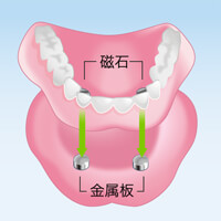 磁性アタッチメント義歯