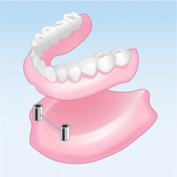 インプラント義歯