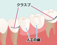 保険の入れ歯（クラスプ義歯）