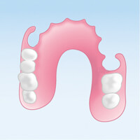 ノンクラスプデンチャー